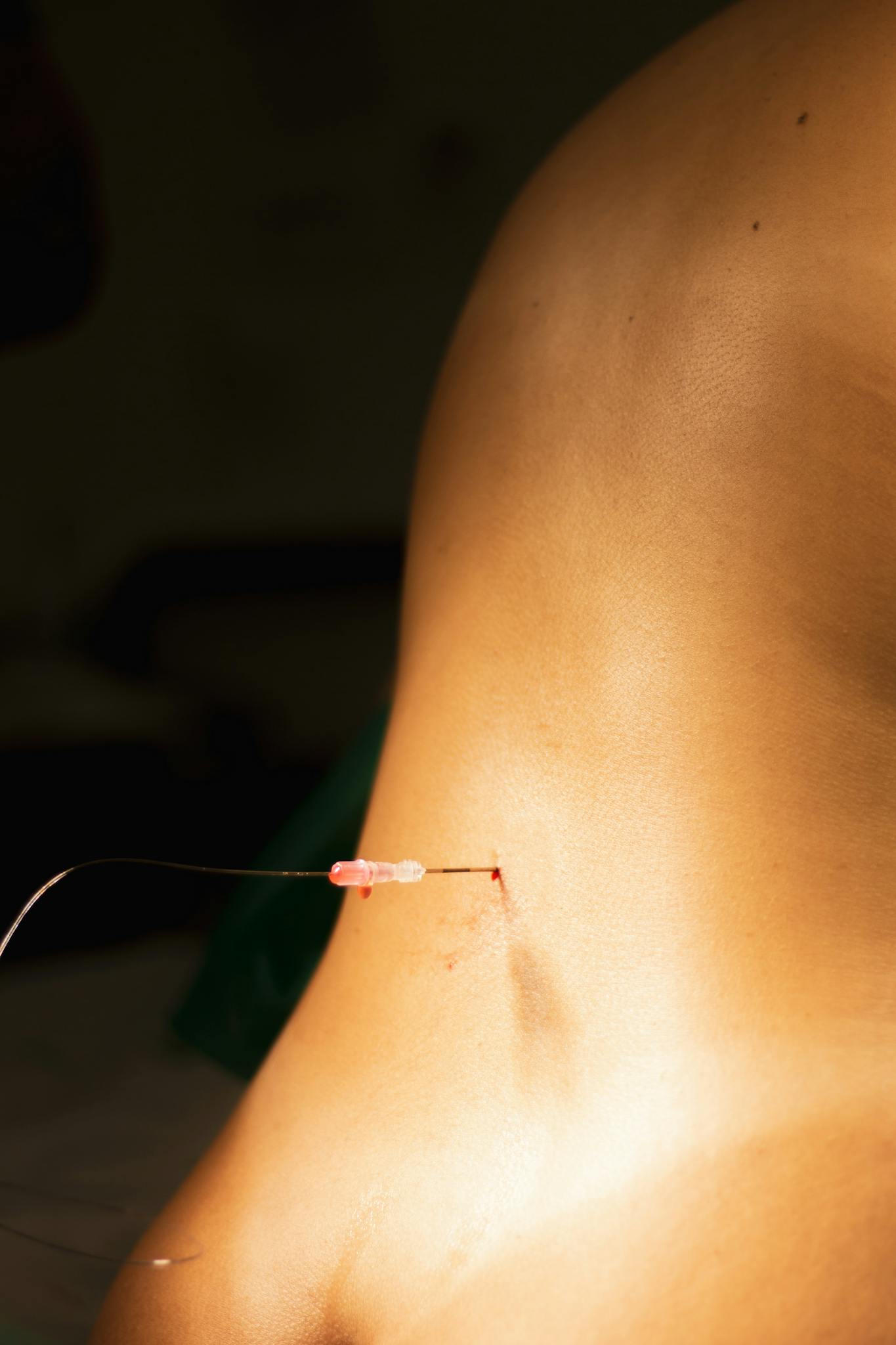 Detailed view of a medical injection, needle in skin, highlighting healthcare practice.