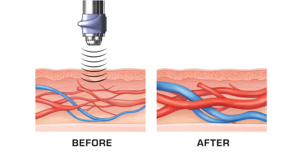 erectile dysfunction treatment Singapore blood flow